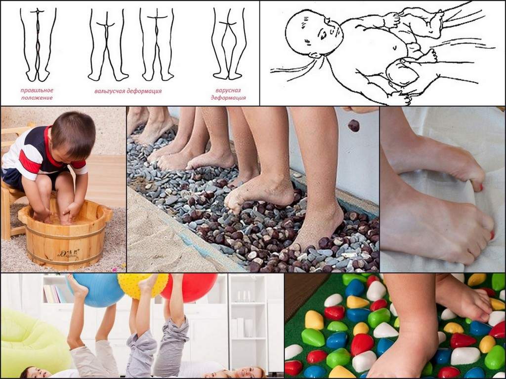 Ребенок на носочках массаж
